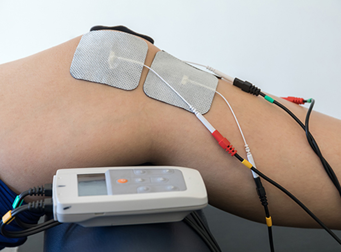 Transcutaneous Electrical Nerve Stimulation (TENS) Image